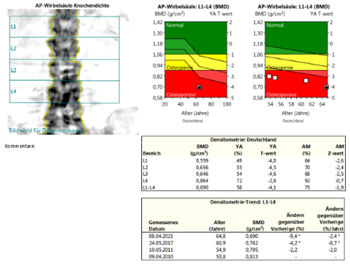dxa-tbs-table-1