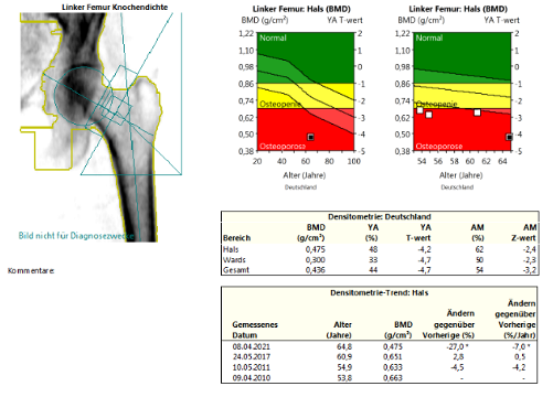 dxa-tbs-table-2