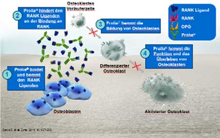 Osteoporose-Knochenjob